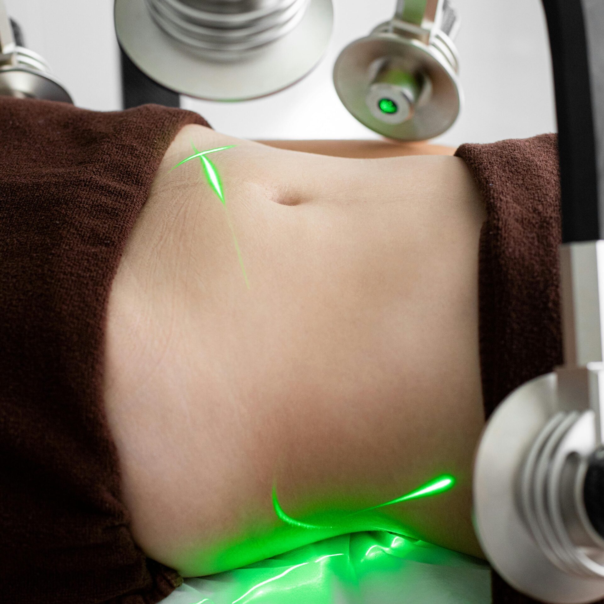 pexels-photo-7772643-7772643a Close-up of a woman's abdomen during a laser liposuction treatment in a medical facility.